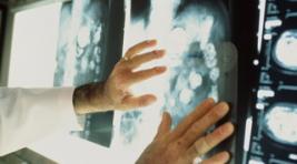 В Хакасии пациентов подвергали рентгену без защиты