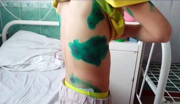 Администрация Сорска выплатила компенсацию покусанному собакой ребёнку