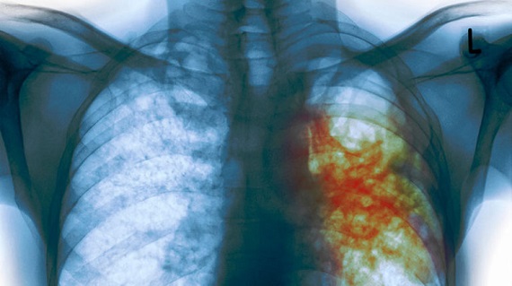 Количество больных туберкулезом в Хакасии снизилось в 2 раза