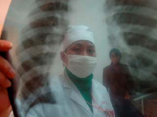 Аскизский район и Абаза просят миллионы на борьбу с туберкулезом
